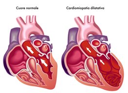 Scompenso Cardiaco - Cardiochirurgia